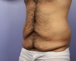 Liposuction