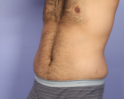 Liposuction before and after photo