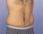 Liposuction Before and after photo