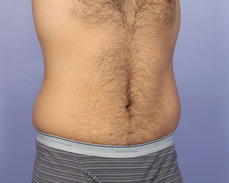 Liposuction before and after photo