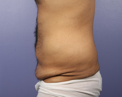 Liposuction before and after photo