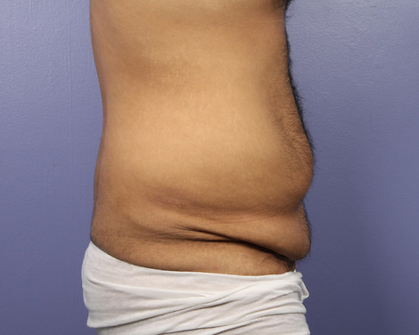 Liposuction before and after photo