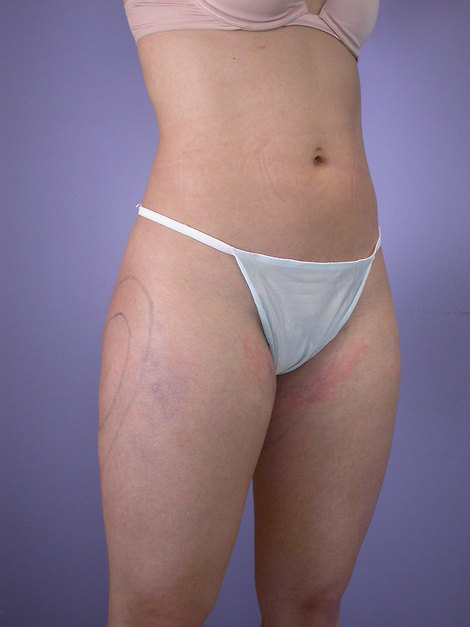 Liposuction before and after photo