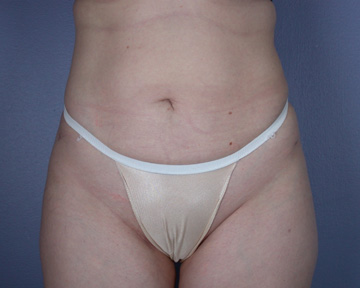 Liposuction before and after photo