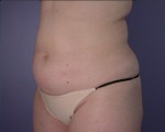 Liposuction Before and after photo