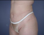 Liposuction Before and after photo