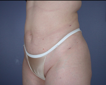 Liposuction before and after photo