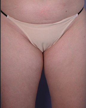 Liposuction before and after photo