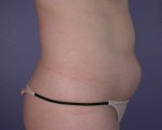 Liposuction Before and after photo