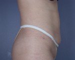 Liposuction Before and after photo