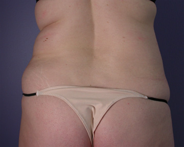 Liposuction before and after photo