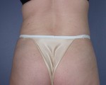 Liposuction Before and after photo