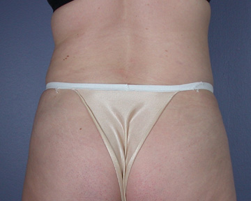 Liposuction before and after photo