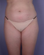 Liposuction Before and after photo