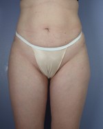 Liposuction Before and after photo