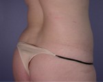 Liposuction Before and after photo