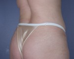 Liposuction Before and after photo