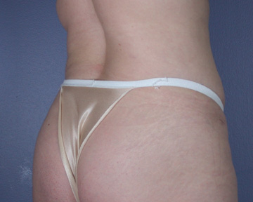 Liposuction before and after photo