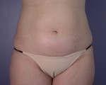 Liposuction Before and after photo