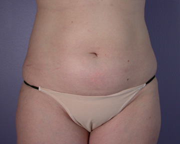 Liposuction before and after photo