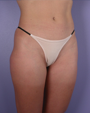 Liposuction before and after photo