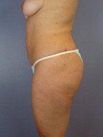 Liposuction Before and after photo