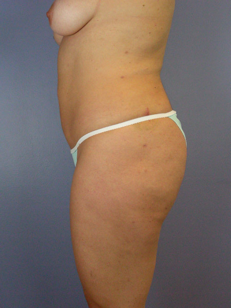 Liposuction before and after photo