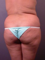 Liposuction Before and after photo