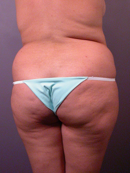 Liposuction before and after photo