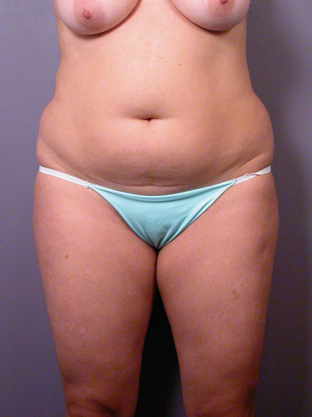 Liposuction before and after photo