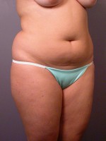 Liposuction