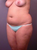 Liposuction Before and after photo