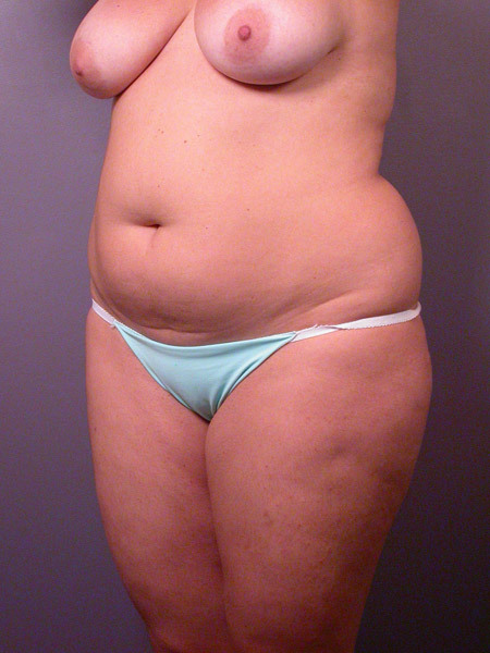 Liposuction before and after photo