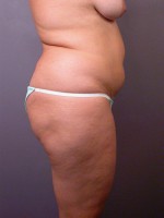 Liposuction Before and after photo