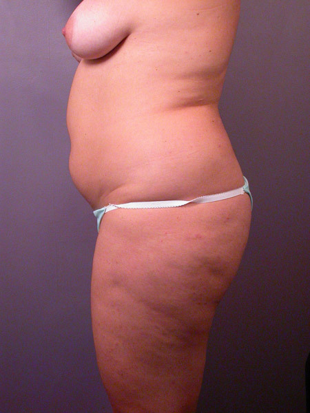 Liposuction before and after photo