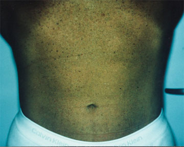 Liposuction before and after photo