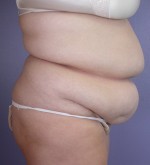 Liposuction Before and after photo