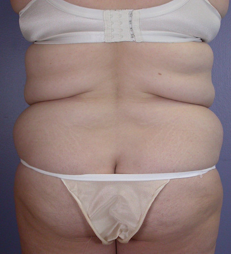 Liposuction before and after photo