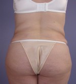 Liposuction Before and after photo