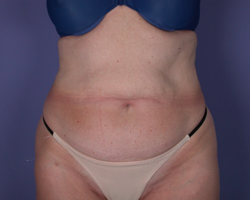 Liposuction before and after photo