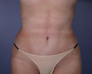 Liposuction before and after photo