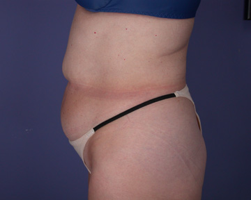 Liposuction before and after photo