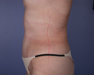 Liposuction before and after photo