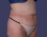 Liposuction Before and after photo