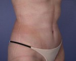 Liposuction Before and after photo