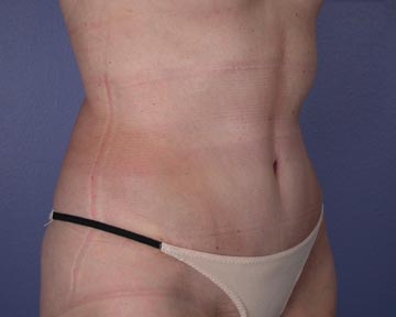 Liposuction before and after photo