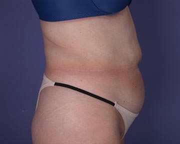 Liposuction before and after photo