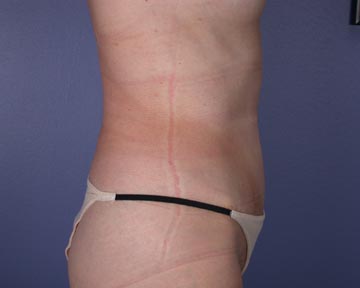 Liposuction before and after photo