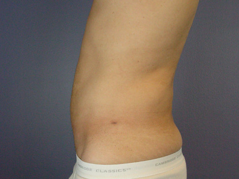 Liposuction before and after photo