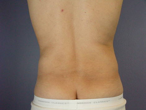 Liposuction before and after photo